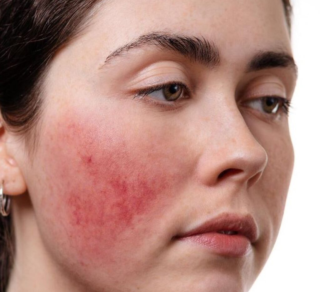 rosacea