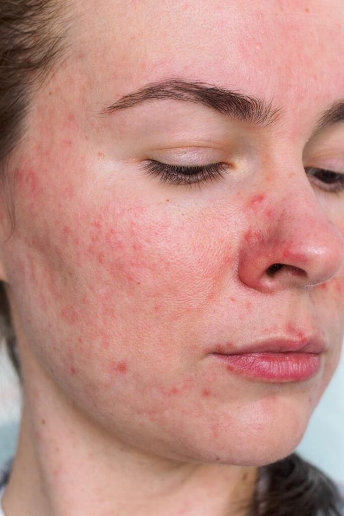 rosacea
